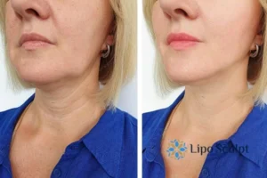 Double chin before and after Hi-Fu treatment 4 Book your double chin treatment Stoulton today! We are here to help!