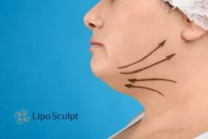 Double chin before and after Hi-Fu treatment 3 Boost your confidence with a Double chin treatment Stoulton