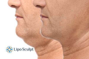 Double chin before and after Hi-Fu treatment 2 Double chin treatment Stoulton from Lipo Sculpt - feel more confident today!
