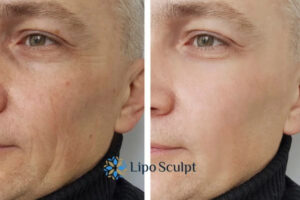 How to Fight Aging Symptoms 3 Fight Aging Symptoms Stoulton With HIFU and Morpheus8 Today!