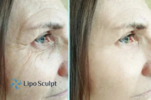 How to Fight Aging Symptoms 2 Do you want to Fight Aging Symptoms Stoulton? Contact Lipo Sculpt today!