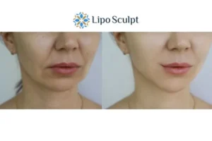 Explaining Total Skin Tightening Treatment And What It Can Do For You 2 Do you want to boost your self confidence? Give Morpheus8 Stoulton a try today!