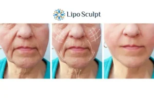 Explaining Total Skin Tightening Treatment And What It Can Do For You 3 Boost your confidence with Morpheus8 Stoulton call our team today!