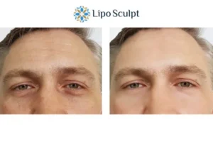 Explaining Total Skin Tightening Treatment And What It Can Do For You 6 Morpheus8 Stoulton book in today to find out more!