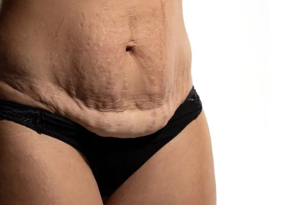 Lost the Weight but Not the Loose Skin? 1 image of womans stomach after weight loss showing loose skin Stoulton
